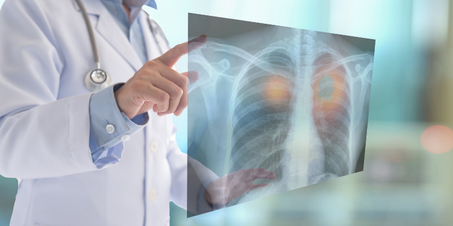 pengobatan kanker paru-paru cepat